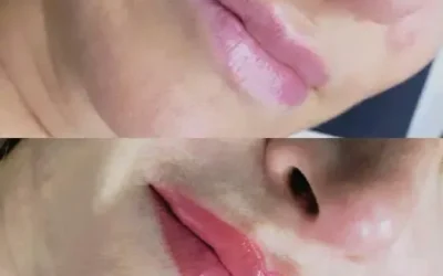 Micro de labios: precisión científica al servicio de la estética